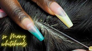 {ASMR} ATTENTIVE Scalp NITPICKING so many  WHITEHEADS | super zoomed