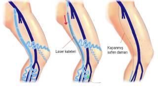 Varis Yarası Belirtileri Nelerdir? Nasıl Tedavi Edilir? (Prof.Dr.Cüneyt Köksoy)