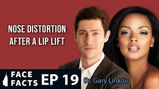 Nose Distortion after a Lip Lift - Dr. Gary Linkov