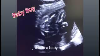 Posterior placenta means boy or girl | Placenta anterior upper mid segment | DCDA Twins genderreveal