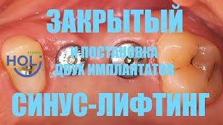 Закрытый синус-лифтинг и постановка двух имплантатов