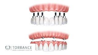 Torrance Implant Retained Hybrid Denture | Redondo Beach Implant-Supported Hybrid Prosthesis