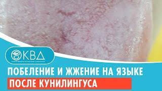  Побеление и жжение на языке после кунилингуса. Клинический случай №664