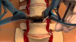 Synthes Spine ProDisc-L Lumbar Total Disc Replacement Demonstration Video