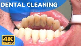Heavy Tartar and Food Removal. Teeth cleaning for Young Male  [4K Quality].
