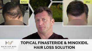 Topical Finasteride & Minoxidil Hair Loss Solution - How To Use