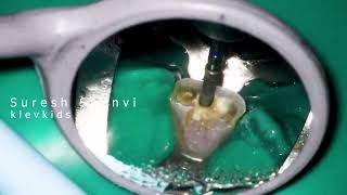 Incisal Access + Microscope ️