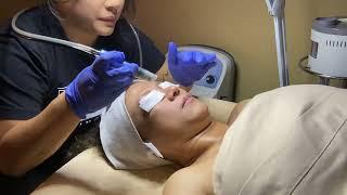 Microdermabrasion #1 (Nikki Duaban)