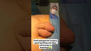 Penil enlargement surgery, Penil lipofilling and Stem cell therapy in Andrology Dr Araz Bayramov