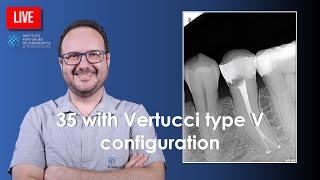  Endo Rtx of 35 with Vertucci type V configuration ▶️ Part 2