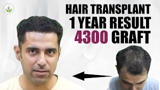 Hair Transplant After 1 Year Result 4300 Graft | Care Well Medical Centre