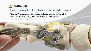 AO Lapidus procedure - corrective osteotomy and fusion of first TMT joint