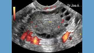 PCOD or polycystic ovary disease, TVS scan, ultrasound, color and spectral Doppler ultrasound video