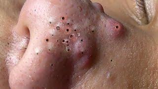 Blackheads & Milia,Huge Nose acne blackheads extraction New This Week Pimple Popping.