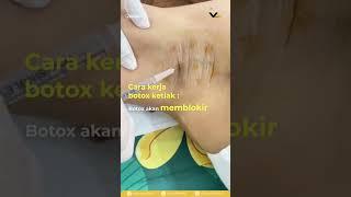 BOTOX KETIAK BY PESONA AYU #klinikkecantikan #shorts #pekanbaru #pesonaayu #botox #botoxtreatment