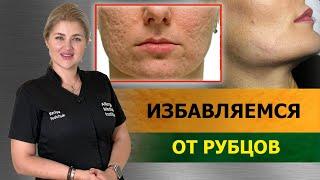 РУБЦЫ и ПОСТАКНЕ. Как убрать ШРАМЫ от прыщей на лице?