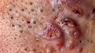  pimple squeezing  Extreme blackhead removal! #3