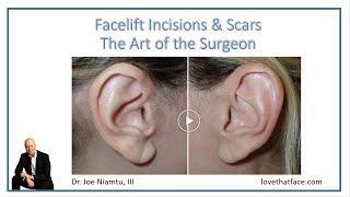 Facelift Incisions & Scars: Watch This if You are considering a facelift #deeplanefacelift