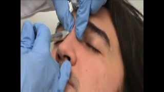 5 minutes Nose Job by Dr. Yuriy Yagudin