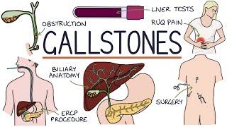 Understanding Gallstones