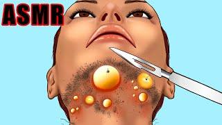 ASMR Animation!: Chin Ingrown Hair & Pimple Removal | Relaxing & Satisfying