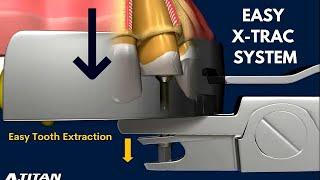 EASY X-TRAC SYSTEM: Easy Tooth Extraction - MINIMALLY-INVASIVE EXTRACTION