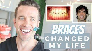 How Braces Changed My Life | Orthodontics | Dr. Nate