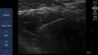 Proximal approach for ultrasound-guided infraclavicular brachial plexus block