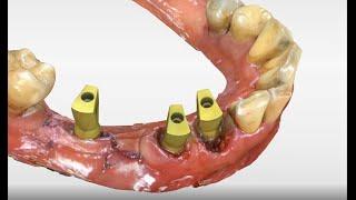 Имплантация зубов при помощи цифровой стоматологии
