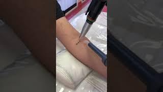 tattoo remove #tattooshorts