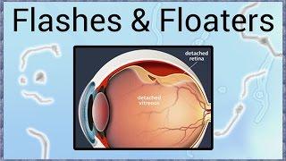 Flashes & Floaters - A Sign of Retinal Detachment