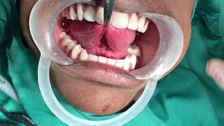 Ankyloglossia - Tongue tie release surgery