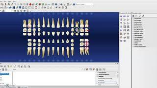 Hard Tissue Charting on Dentrix