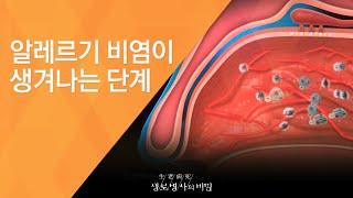 알레르기 비염이 생겨나는 단계 - (2010.3.11_324회 방송)_코가 막히면 인생도 막힌다 - 알레르기 비염