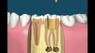 Root canal treatment animation