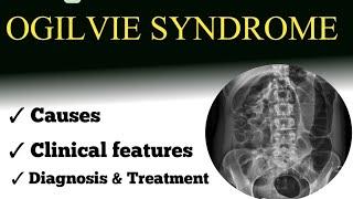 ogilvie syndrome | causes | clinical features | diagnosis | treatment