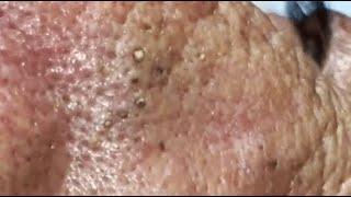 WOOW !! A PILE OF BLACKHEADS IN THE NOSE OF AN ELDERLY MAN  #relaxing  #blackheads