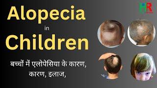 Alopecia in children || बच्चों में एलोपेसिया के कारण, बच्चों में एलोपेसिया का इलाज,