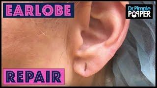 After Years of Heavy Earrings... Earlobe Repair