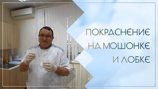  Покраснение на мошонке и лобке. Клинический случай №94