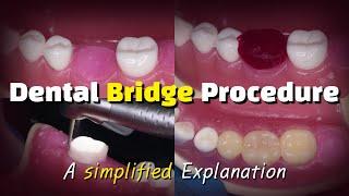 Dental Bridge Procedure