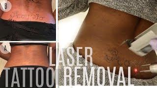 Watch My TRAMP STAMP Disappear!| Laser Tattoo Removal on Brown Skin | LaserAway