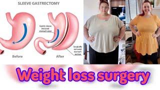 Surgery for weight loss I Bariatric surgery for weight loss in Noida, Delhi