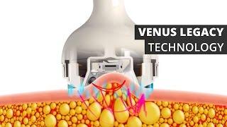 Venus Legacy™ Technology