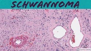 Schwannoma: 5-Minute Pathology Pearls