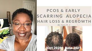 Early Scarring Alopecia: Hair Loss and Regrowth Pt. 1