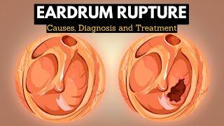 The Science Behind Eardrum Rupture: Explained in Simple Terms