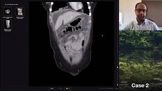 Isolation tutorial: Abdominal CT #3 with Vikas Shah