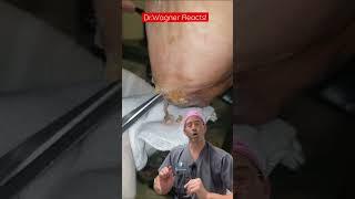 MAGGOT THERAPY  #shorts #woundcare