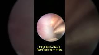 Forgotten DJ Stent Removed after four years #shorts